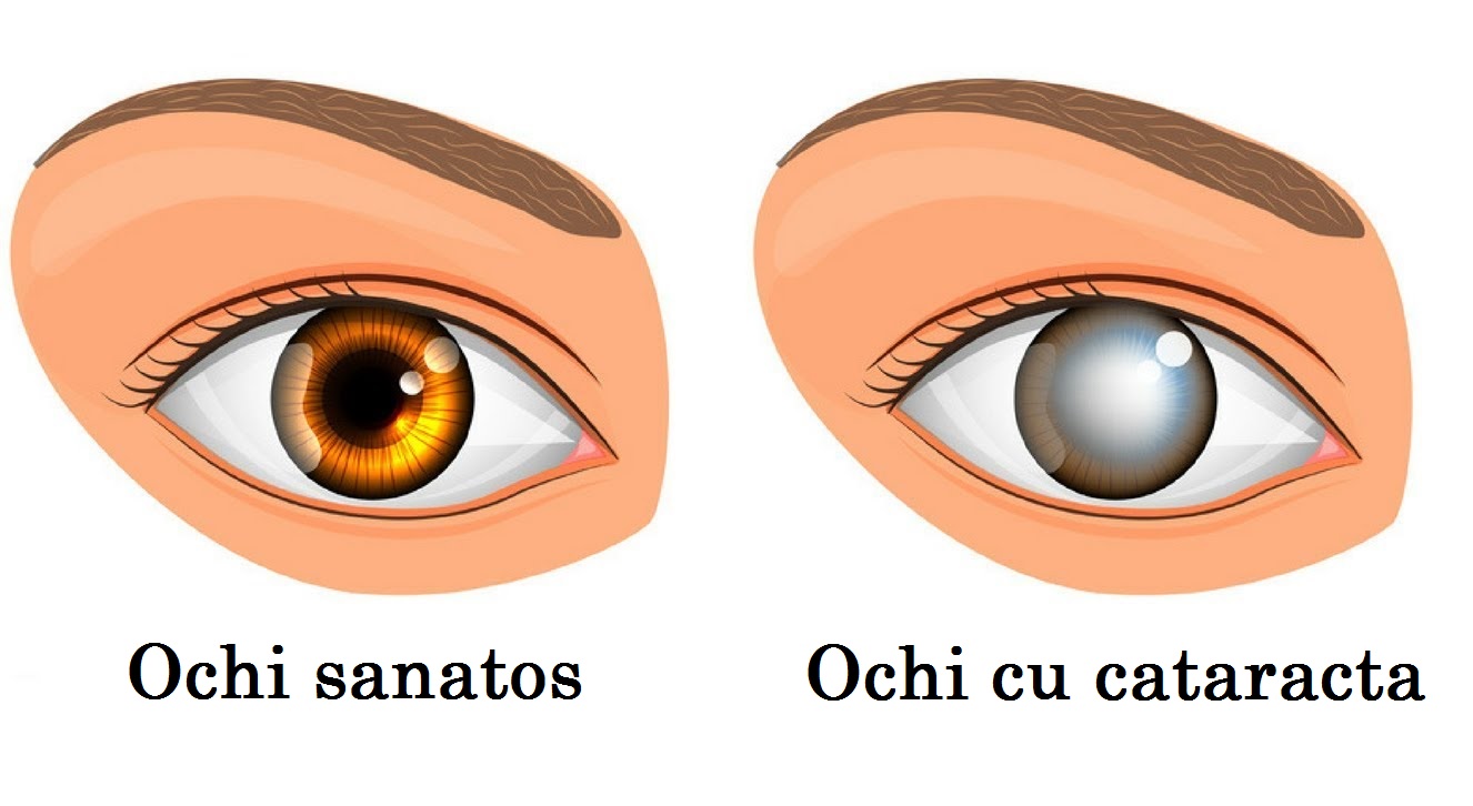 Eliminarea cataractei viziune nouă. Chirurgia cataractei - pregătire și procedură